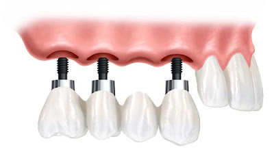 Trồng răng implant cho trường hợp bị mất răng