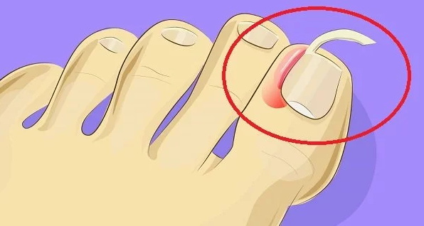  Ingrown Toenail 