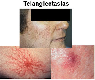 Teleangiectasia