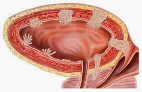 Bladder Cancer Treatment