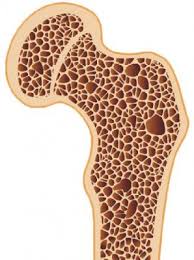 Cara Mengatasi Penyakit Osteoporosis