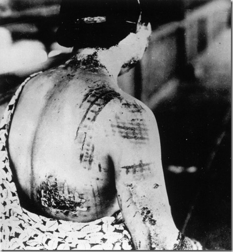 HIROSHIMA  A-BOMB VICTIM WWII
