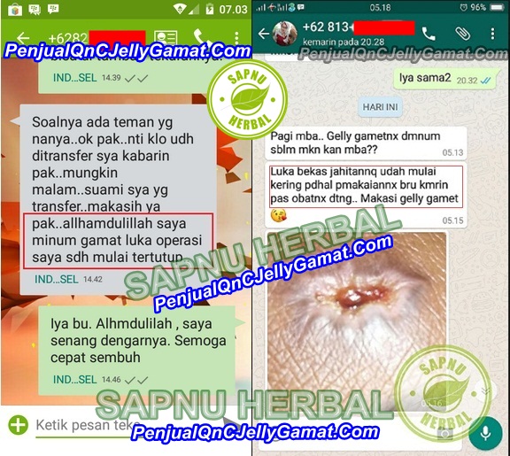 Cara Menghilangkan Bekas Luka