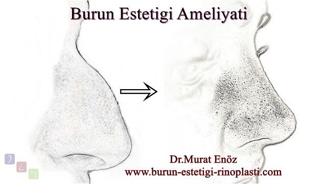 Burun estetiği ameliyatı neden yapılır? - Doğal burun estetiği - Doğal burun ucu - Sıkma burun görünümü - Plastik burun görünümü - Kalkık burun görünümü