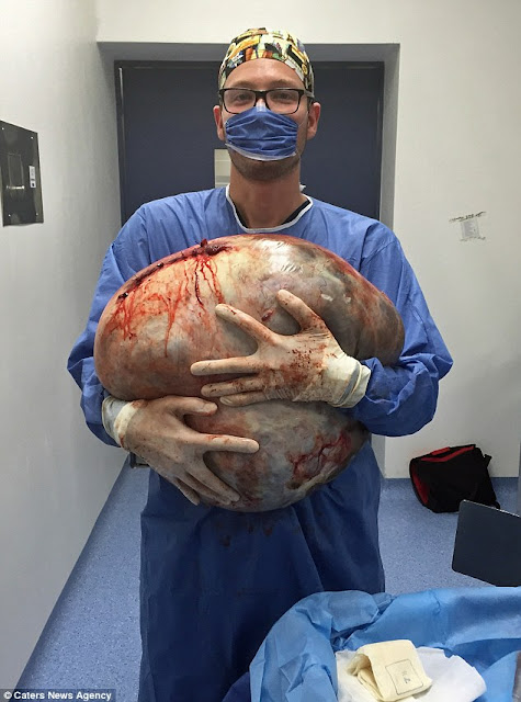 24-Year-Old Woman Has the World's Biggest Cyst Removed After Her Organs Were Crushed