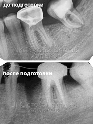 Рентген до и после подготовки к ортодонтическому лечению