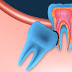 Răng khôn và thời điểm cần nhổ bỏ