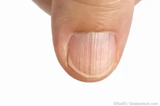 Vertical Ridges in Fingernails