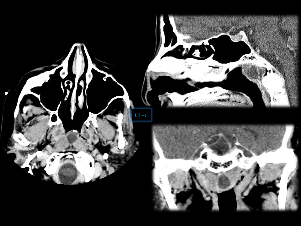 60 year old female headache