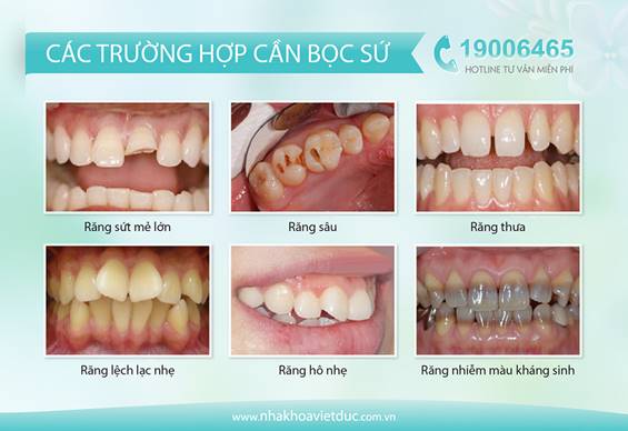 boc-rang-su-ceramill-co-nguy-hiem-khong-01