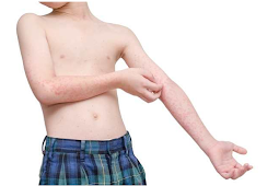 Cold allergy symptoms in children and its Prevention