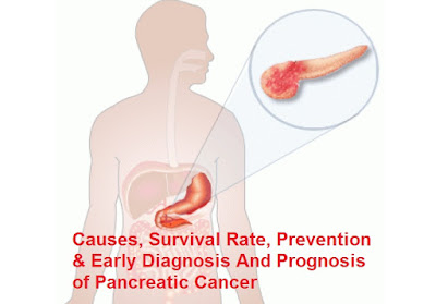 Pancreatic Cancer : Causes, Survival Rate, Prevention and Early Diagnosis And Prognosis