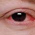 Cara mencegah mata berlemak dan cara mengatasinya