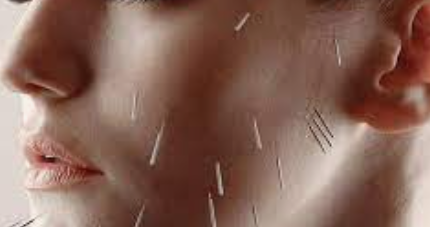 The Ancient Art of Acupuncture, A Modern Solution for Hormonal Acne.