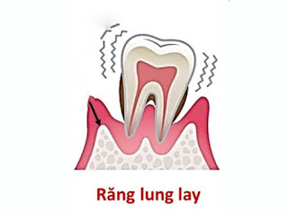 Răng lung lay phải làm gì để phục hồi ?