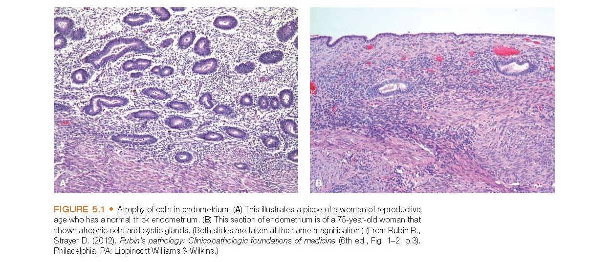 Atrophy of cells in endometrium. (A) This illustrates a piece of a woman of reproductive age who has a normal thick endometrium