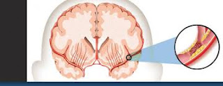 Tanaman Obat Stroke yang Alami, apakah stroke bisa sembuh total?, cara tradisional memulihkan stroke ringan