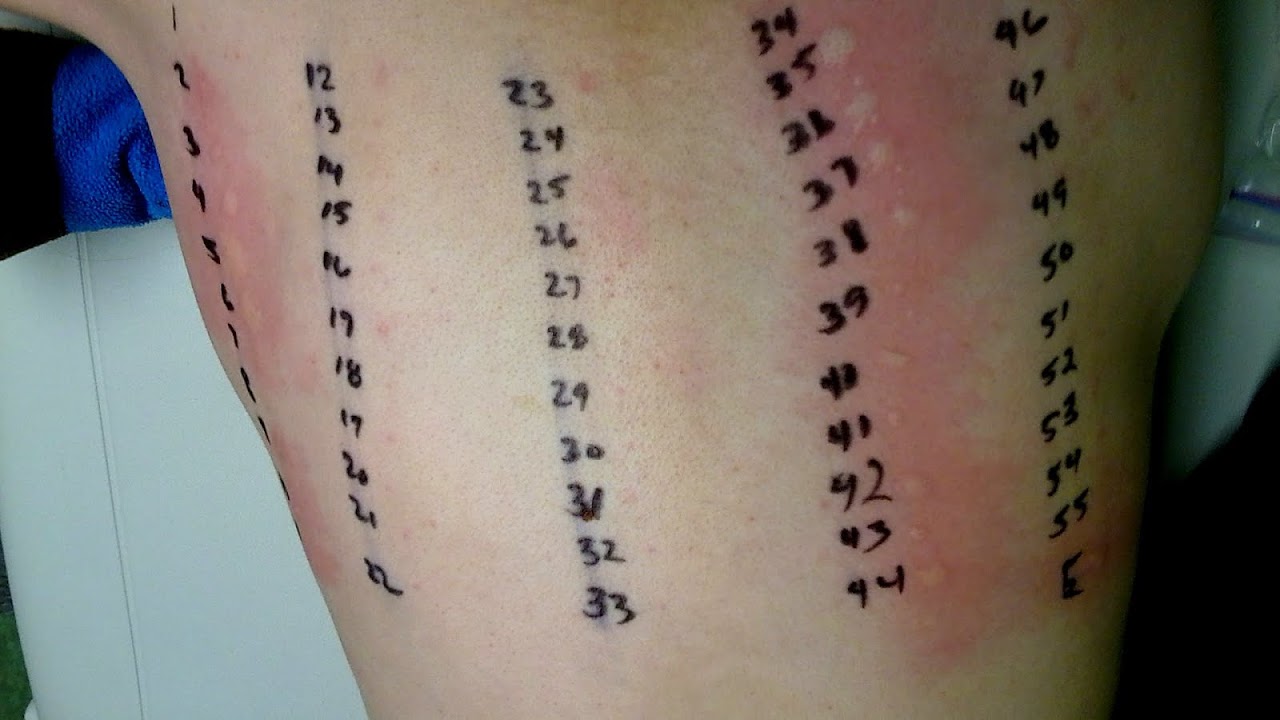 How To Do An Allergy Test