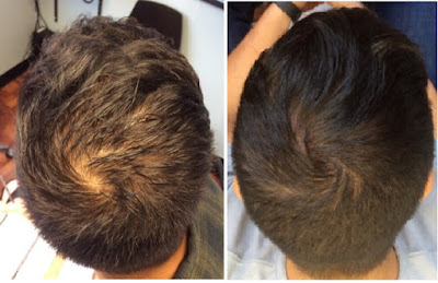 Hair Treatment in jaipur by best hair doctor