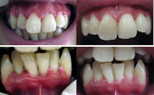 <Img src ="Imágenes-periodontitis-sin-y-con-tratamiento.jpg" width = "593" height "368" border = "0" alt = "Fotos antes y después de periodontitis tratada por sarro dental.">