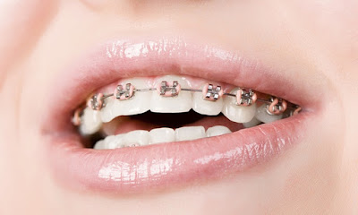 Bạn đã biết quy trình niềng răng nhanh tại nha khoa