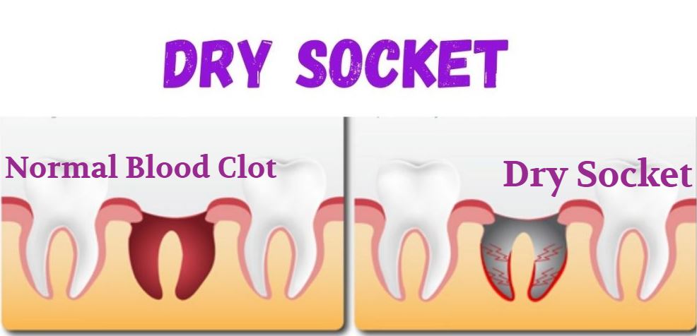 How to get dry socket