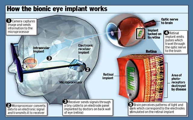 بشرى للمكفوفين رقاقة الكترونبة جديدة يتم تركيبها في العين تعيد البصر 