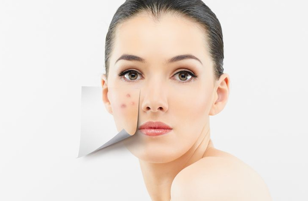 woman with acne