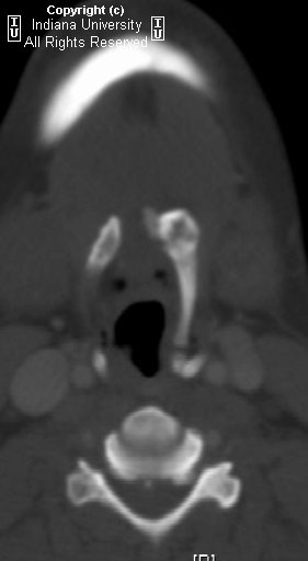 Calcified thyroglossal duct