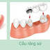 Quy trình làm răng giả tại nha khoa 