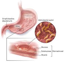 Obat Infeksi Lambung