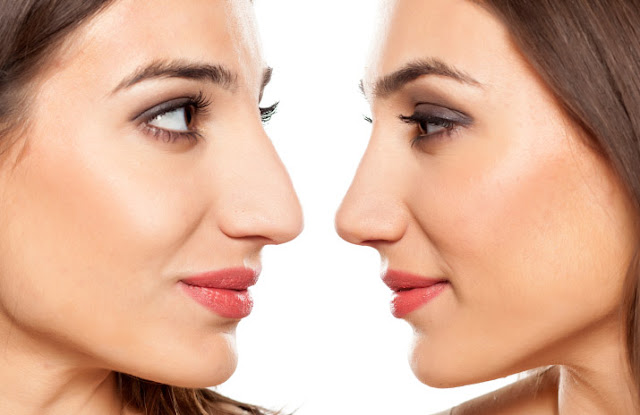 Rhinoplasty Facts