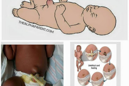 Koin Untuk Mencegah Pusar Anak Bodong, Perlukah?