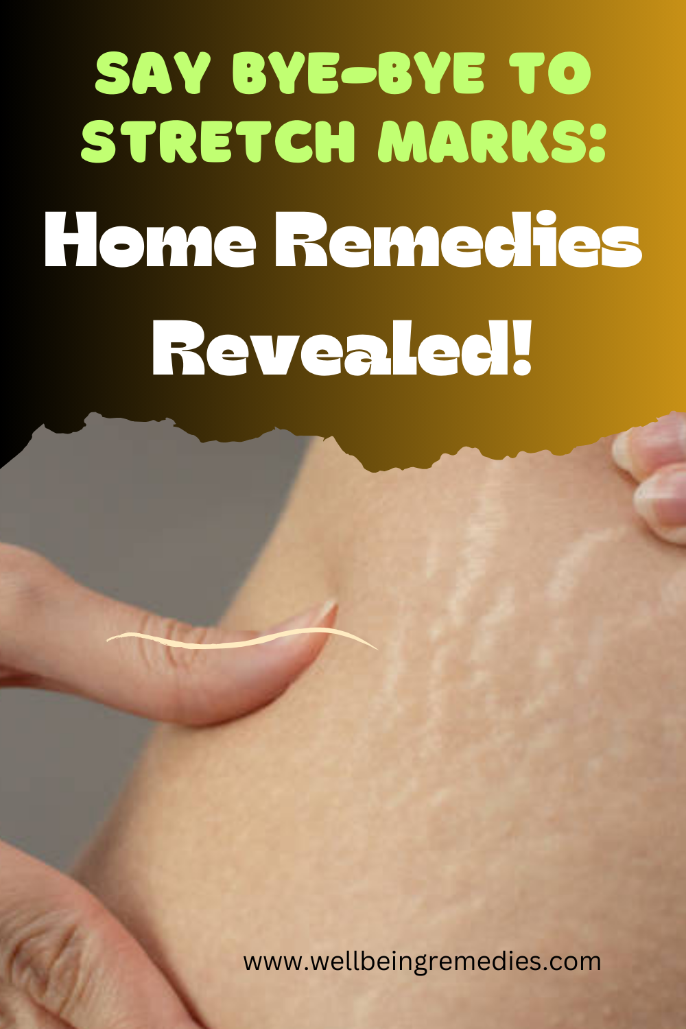 Say Bye-Bye to Stretch Marks: Home Remedies Revealed!