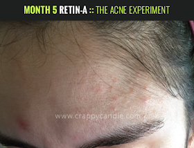 Retin-A Irritation (Month 5) :: The Acne Experiment