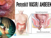 Cara Menghilangkan Benjolan Wasir Luar Secara Alami