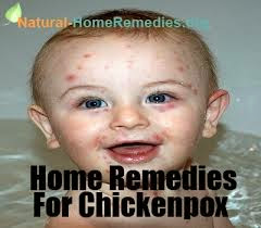  Home Remedies for Curing Chickenpox