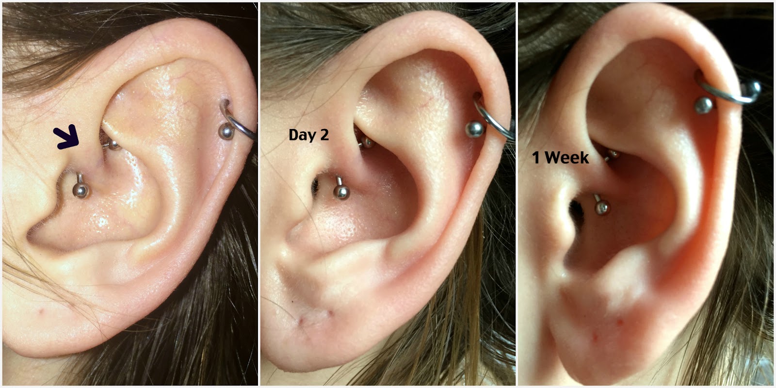 The Daith Piercing Is It Really A Cure For Migraine