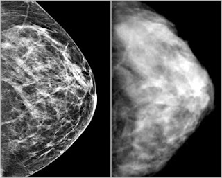 mammograms