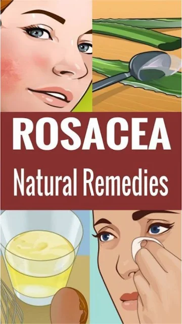 The Best Natural Remedies for Rosacea