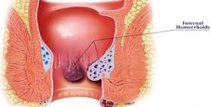 Obat Alami Mengempeskan Wasir