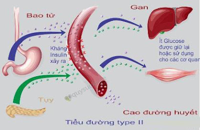 bệnh tiểu đường