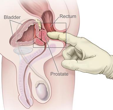 Light treatment 'an immense jump forward' for early prostate malignancy treatment