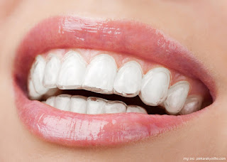 pilih invisalign atau kawat gigi