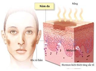 Cách trị nám da mặt bằng tinh bột nghệ