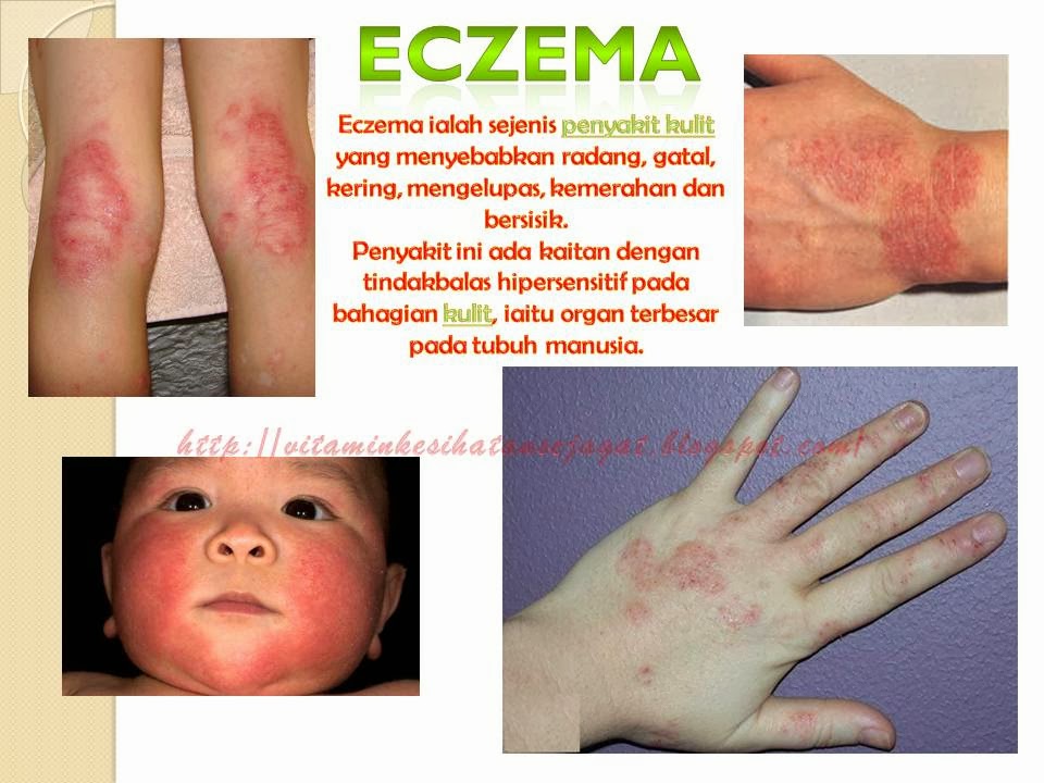 Vitamin Shaklee untuk Masalah Eczema Shaklee Subang Jaya 