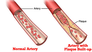 Atherectomy vs Angioplasty: How Dangerous Is An Atherectomy