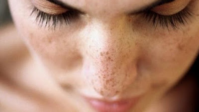 Cara alami mengatasi noda hitam pada kulit wajah  Cara Alami Mengatasi Noda Hitam pada Kulit Wajah