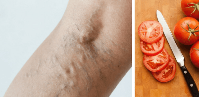 remedio de tomate para combatir las varices