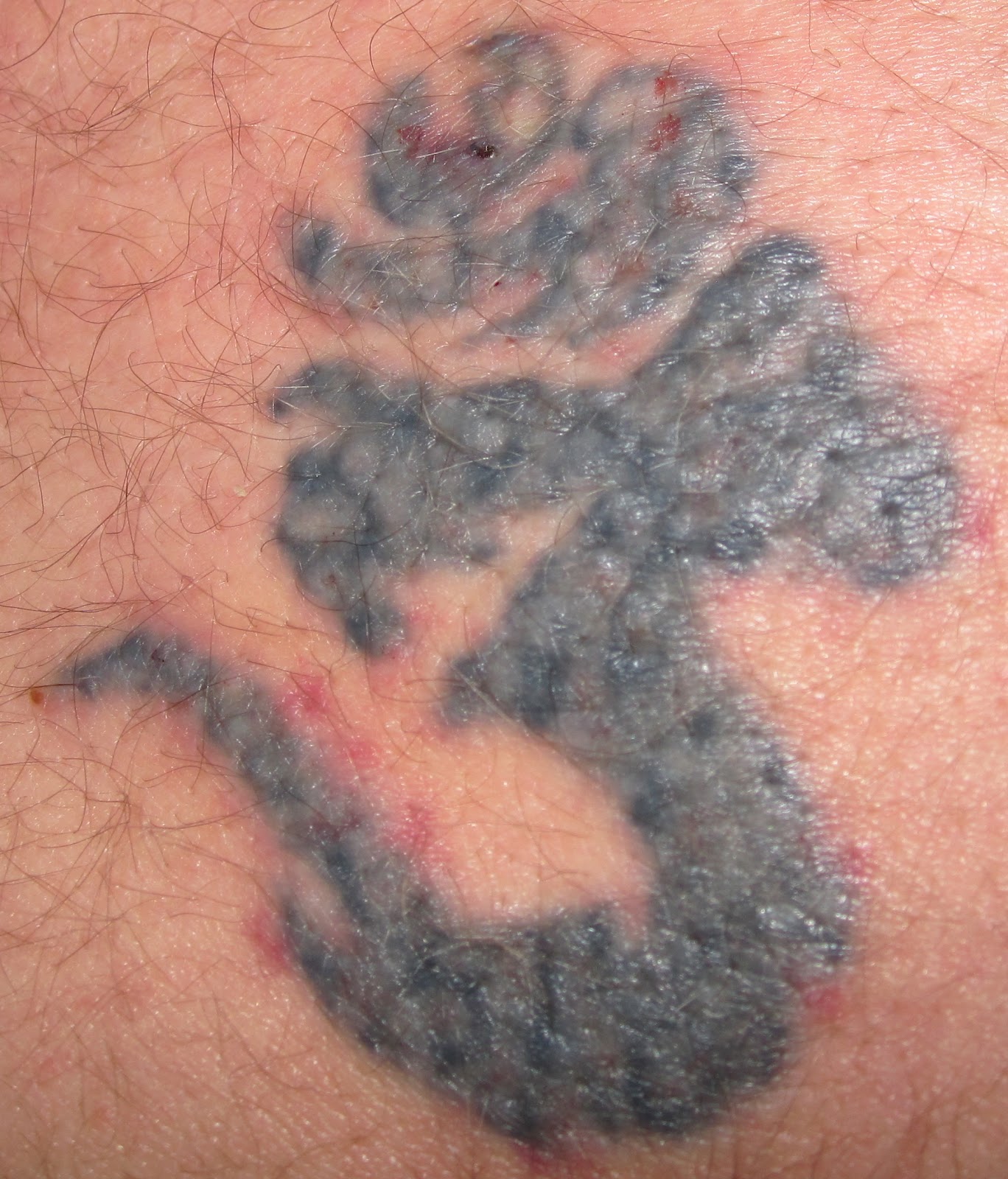 Laser Tattoo Removal: Laser Tattoo Removal Timeline - First Post